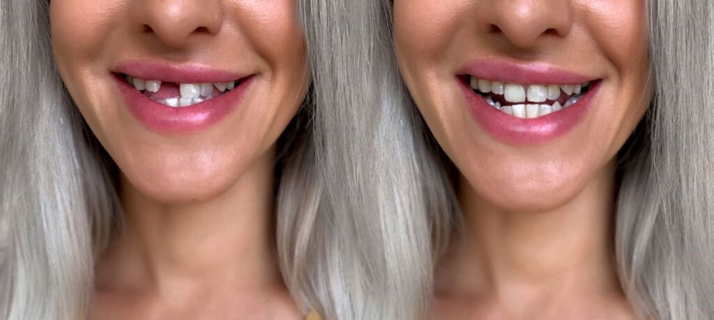 Retrouvez Votre Sourire et Votre Confiance : Le Guide Complet de la Prothèse Dentaire sur Implant