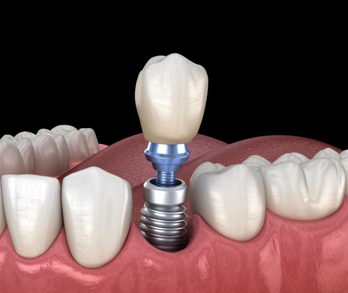 Pourquoi Choisir l'Implant Plutôt Qu'un Dentier Classique ?