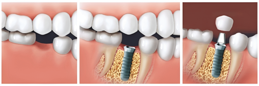 avantages de la prothèse et de l’implant dentaire