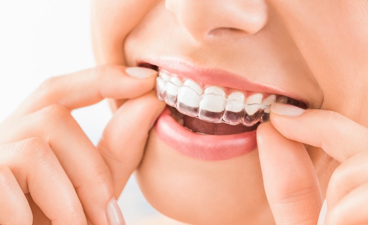 Aligneurs transparents Invisalign