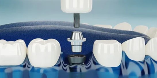 Implant Dentaires